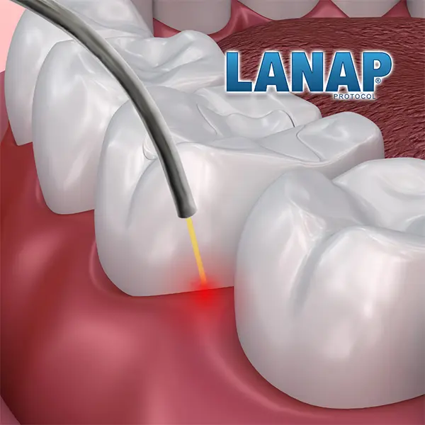 LANAP